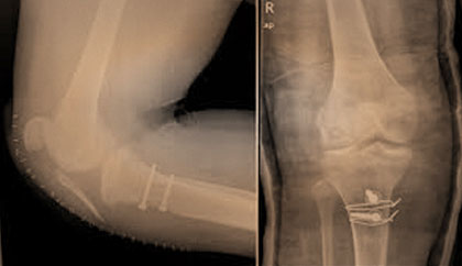 Prótesis de rodilla